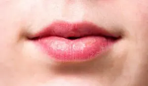 Herpes labial