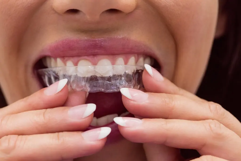 Como clarear os dentes: gel de babosa sendo aplicado em molde dental caseiro.